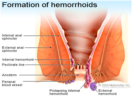 Picture of hemorrhoids